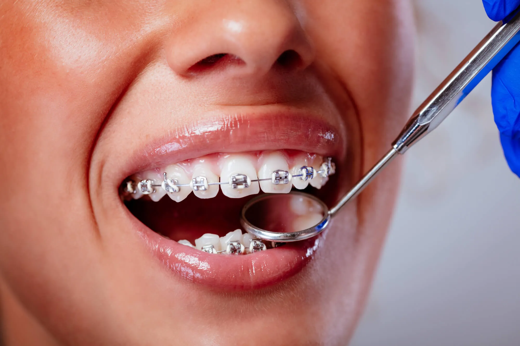 Jenis-Jenis Braces: Panduan Lengkap, Mudah Faham & Cara Pilih Yang Sesuai
