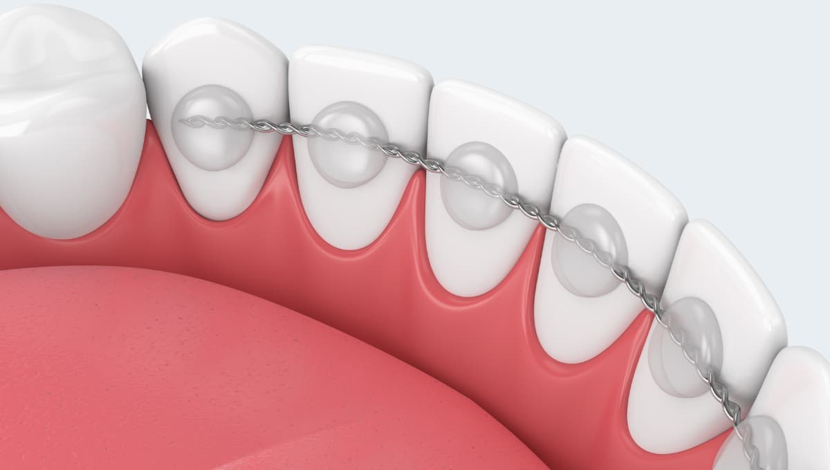 Kenapa Perlu Pakai Fixed Retainer Lepas Braces? Ini Sebab Gigi Boleh Jadi Jarak Semula