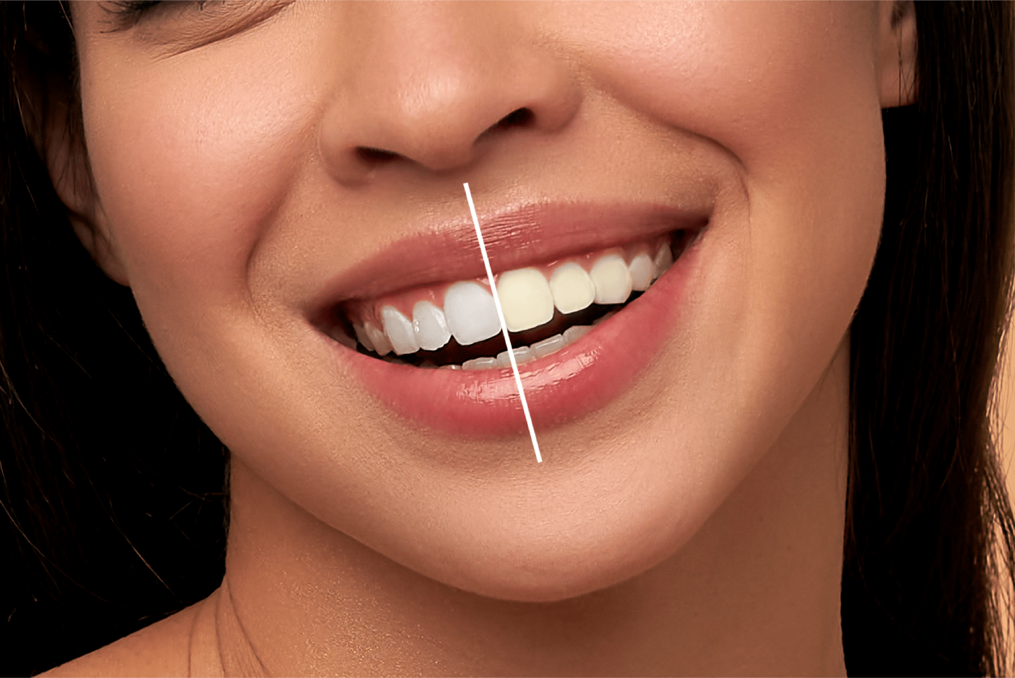 Whitening Dah Buat Tapi Gigi Masih Kuning? Ini Sebabnya